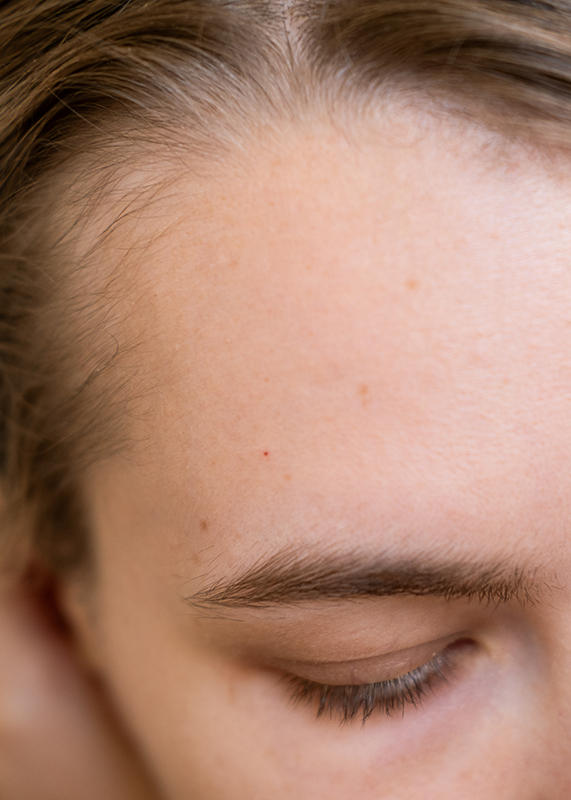 Hairline Lowering Transplant