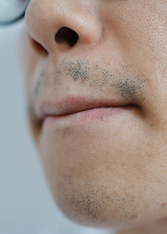 Beard & Mustache Hair Transplants